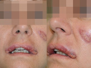 DIY Botched Plastic Surgery
